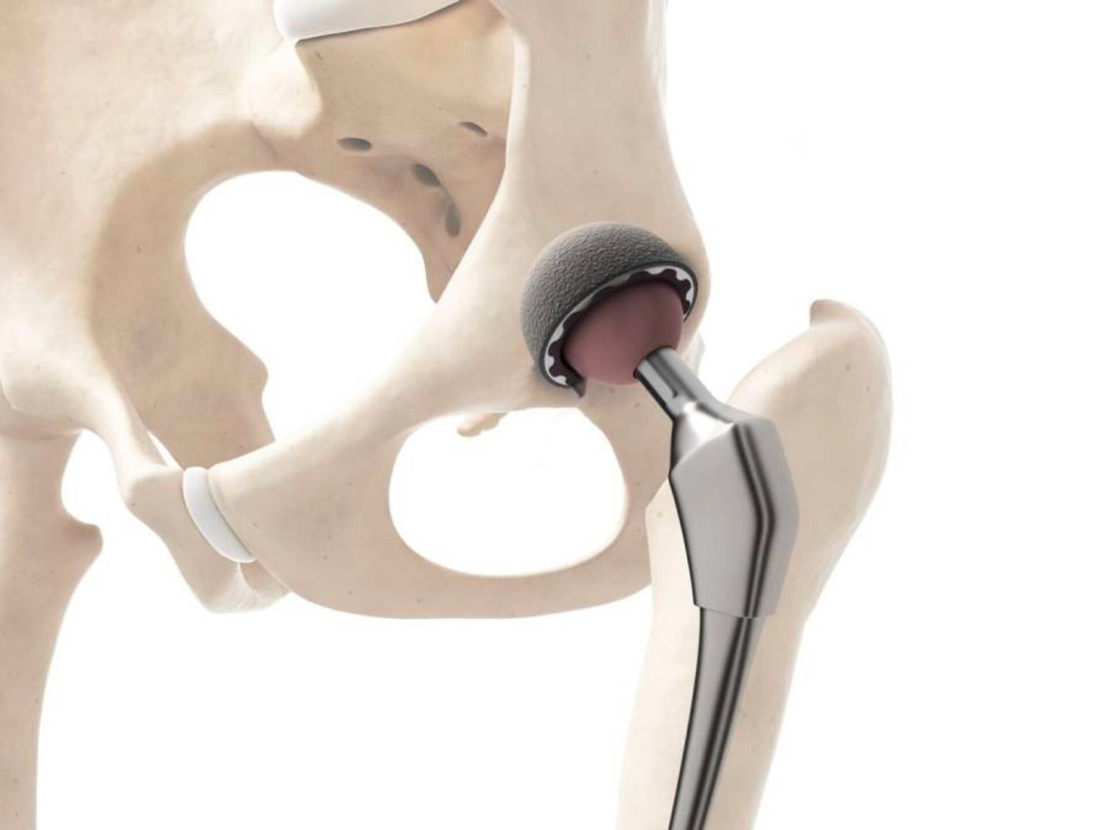 Protesis de Cadera Traumatologo Ortopedista en Tijuana https://drcisnerosortopedia.com