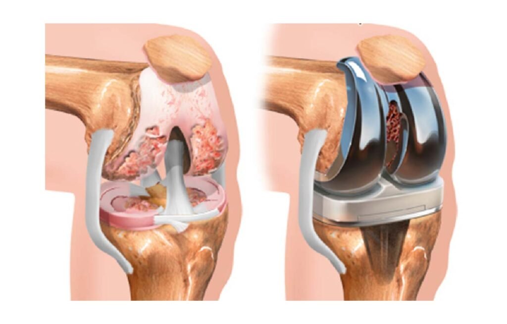 cirugia protesis rodilla artroplastia rodilla lima peru 01 Traumatologo Ortopedista en Tijuana https://drcisnerosortopedia.com