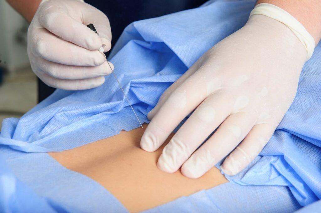 Inyeccion Epidural para Dolor de Ciatica Tijuana Traumatologo Ortopedista en Tijuana https://drcisnerosortopedia.com