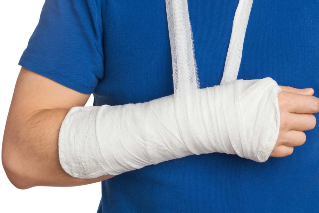 Aplicacion de Yeso para Fractura de Muneca en Tijuana Traumatologo Ortopedista en Tijuana https://drcisnerosortopedia.com