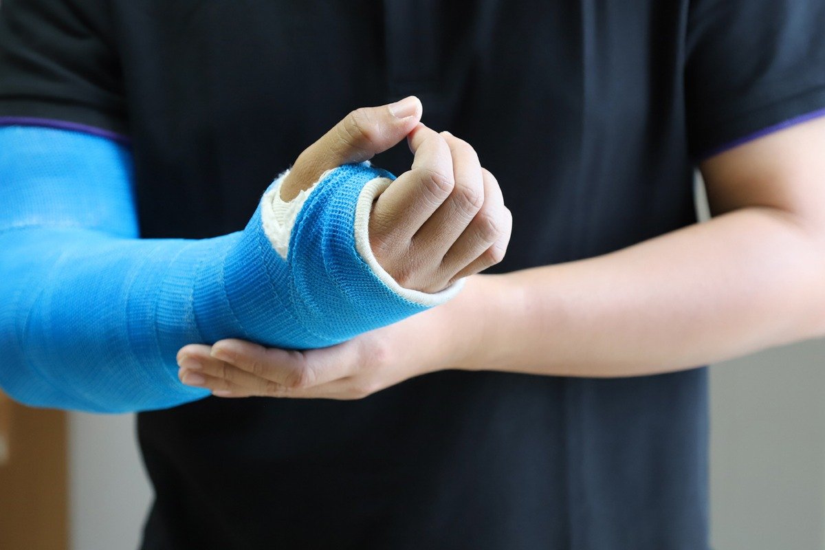 Fractura de Brazo en Tijuana