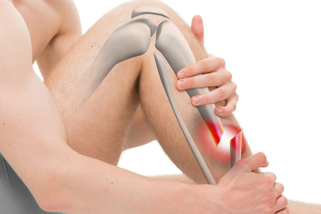 Fractura de Pierna en Tijuana Traumatologo Ortopedista en Tijuana https://drcisnerosortopedia.com