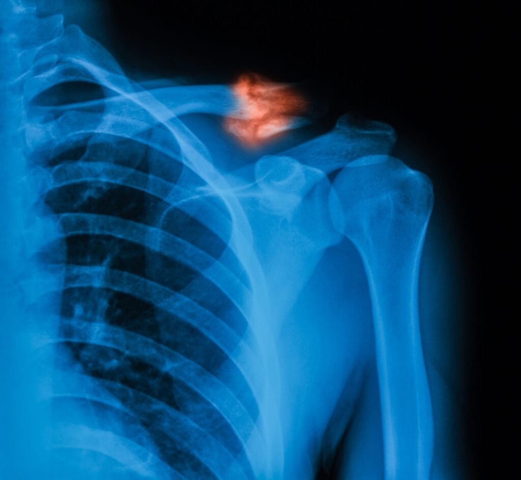 Fractura de Clavicula en Tijuana Traumatologo Ortopedista en Tijuana https://drcisnerosortopedia.com