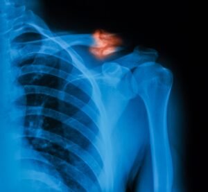 Fractura de Clavicula en Tijuana Traumatologo Ortopedista en Tijuana https://drcisnerosortopedia.com