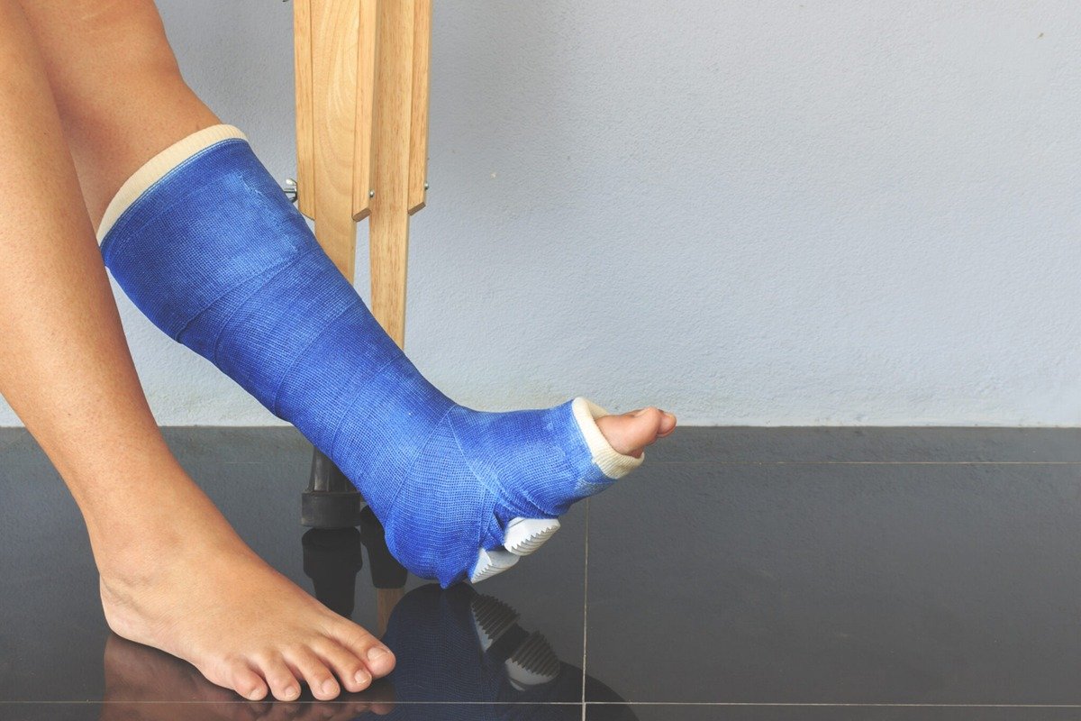 inmoblizacion de tobillo por fractura en tijuana