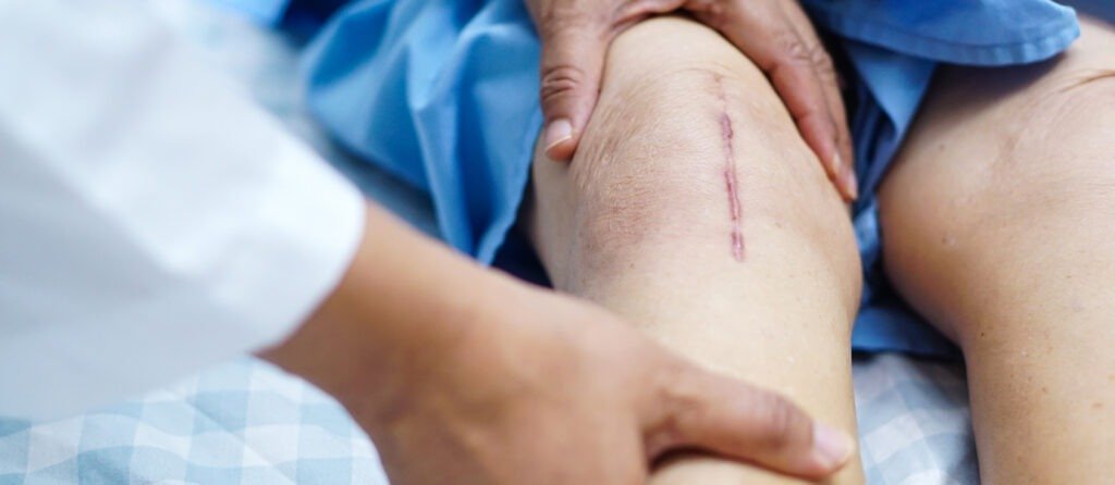 Como Recuperarse de Cirugia en Tijuana